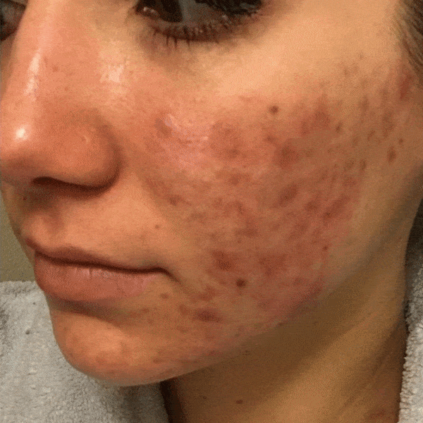 maschera viso purificante tè